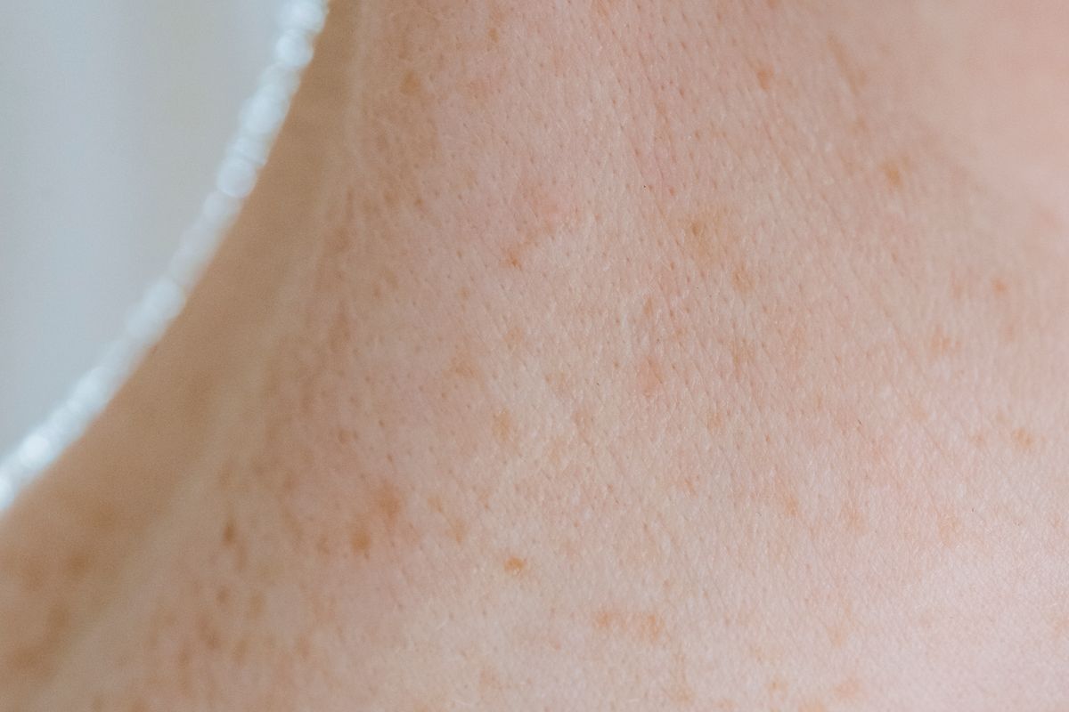 Upper arm skin in soft light showing small raised bumps